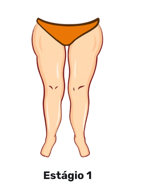Lipedema — Estágio 1