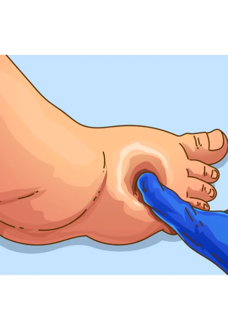 Lipedema — Sinal de cacifo (inchaço)