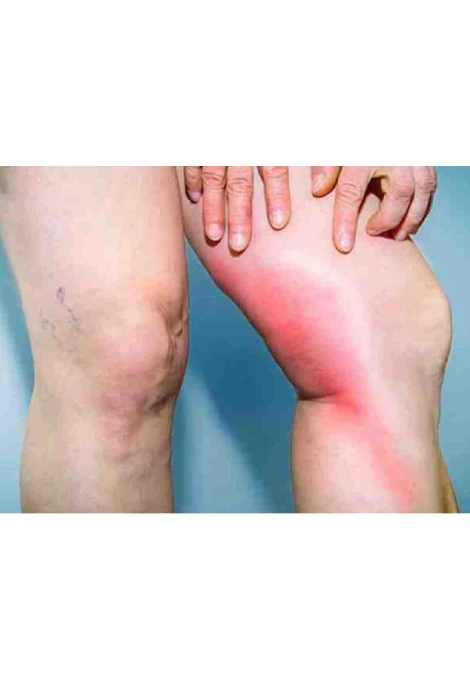 Lipedema — Dor e inflamação