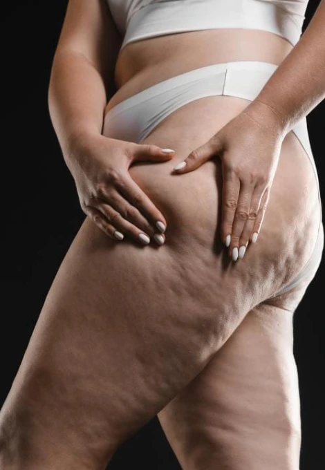 Lipedema — Nódulos sob a pele
